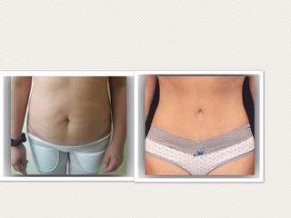 Abdominoplastia 