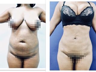 Lipoescultura