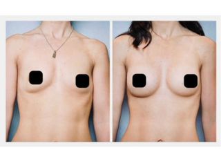 Mamoplastia de Aumento