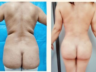 Lipoescultura y lipoinhección glútea