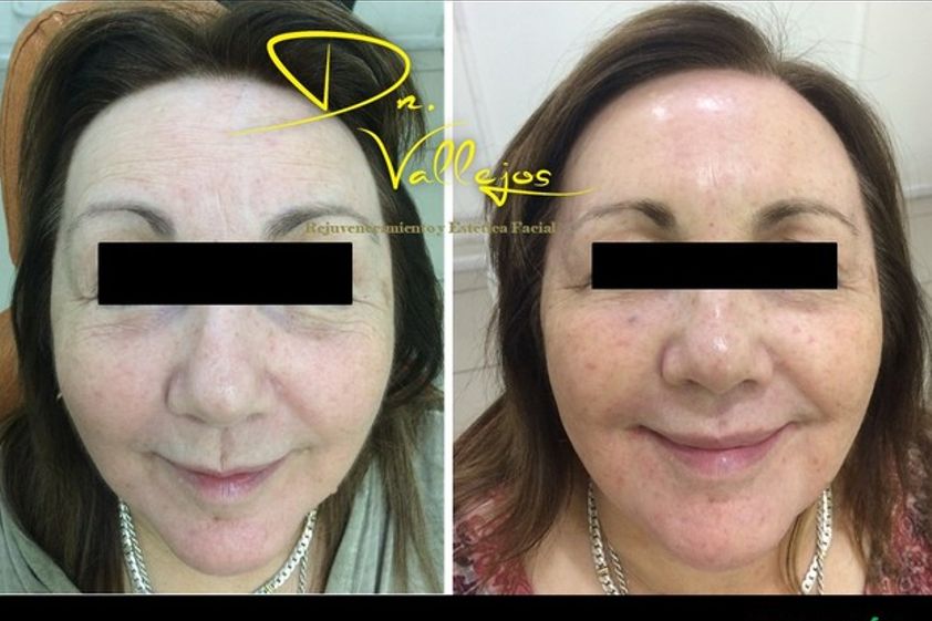 Plasma rico en plaquetas antes y después - 624274