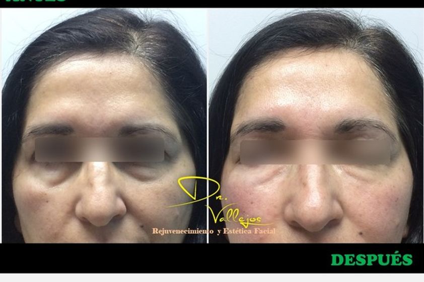 Tratamiento de ojeras antes y después - 626606