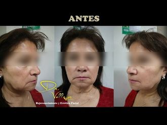 Hilos tensores - 632083