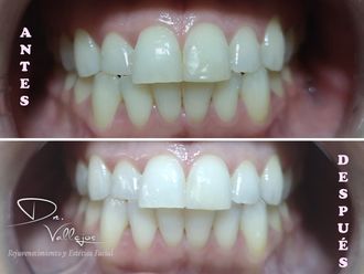 Blanquear dientes - 638349
