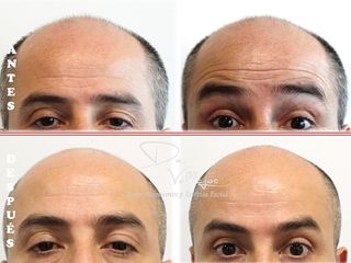 Botox arrugas dinámicas de la frente en Hombre