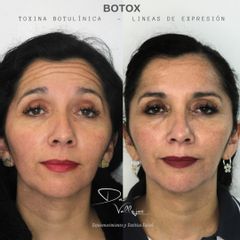 Botox - Dr. Julio Vallejos