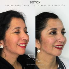 Botox - Dr. Julio Vallejos