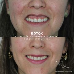 Bótox - Dr. Julio Vallejos