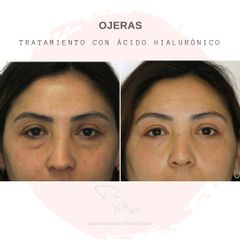 Tratamiento de ojeras con ácido hialurónico - Dr. Julio Vallejos