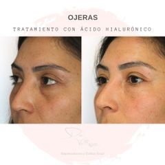 Tratamiento de ojeras con ácido hialurónico - Dr. Julio Vallejos
