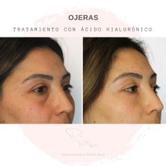 Tratamiento de ojeras con ácido hialurónico - Dr. Julio Vallejos
