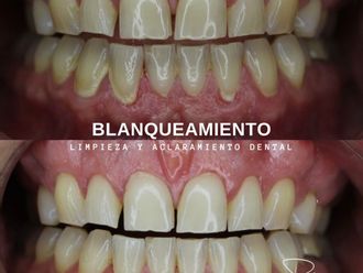 Blanquear dientes antes y después - 860931