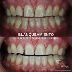 Blanqueamiento dental - Dr. Julio Vallejos