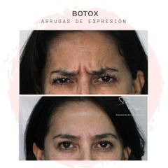 Botox Tercio superior