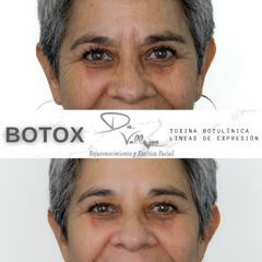 Botox - Dr. Julio Vallejos