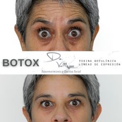 Botox - Dr. Julio Vallejos