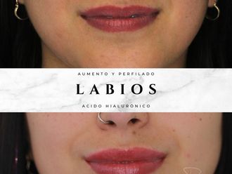 Aumento de labios antes y después - 871702