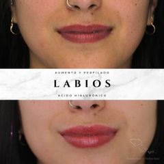 Aumento de labios - Dr. Julio Vallejos