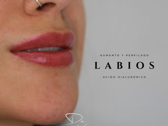 Aumento de labios antes y después - 871703