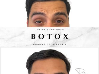 Bótox antes y después - 877725