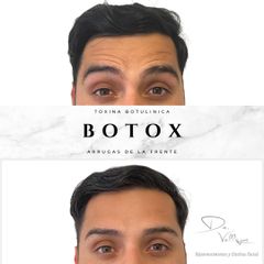 Botox - Dr. Julio Vallejos