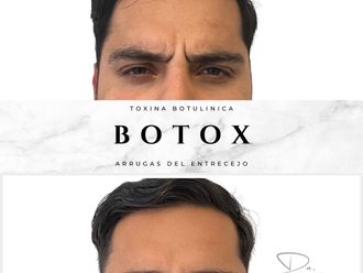 Bótox antes y después - 877726