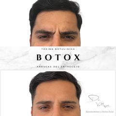 Botox - Dr. Julio Vallejos