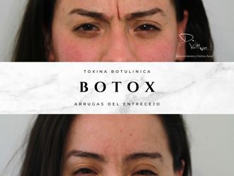 Bótox antes y después - 877809