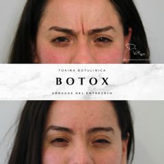 Botox Entrecejo - Dr. Julio Vallejos