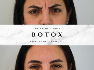 Bótox antes y después - 877810