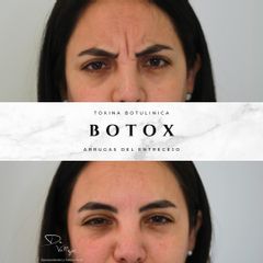Botox Entrecejo - Dr. Julio Vallejos