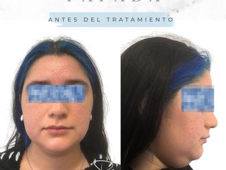 Lipopapada antes y después - 877811