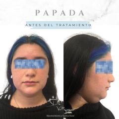 Reducción de papada con Lipolítico - Dr. Julio Vallejos