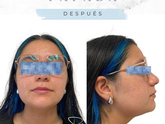 Lipopapada antes y después - 877812