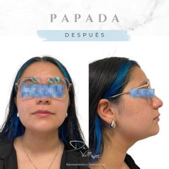 Reducción de papada con Lipolítico - Dr. Julio Vallejos
