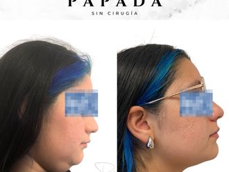 Lipopapada antes y después - 877813