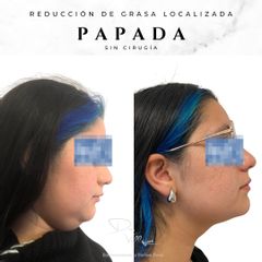 Reducción de papada con Lipolítico - Dr. Julio Vallejos