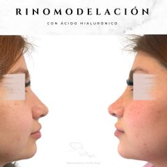 Rinomodelación - Dr. Julio Vallejos