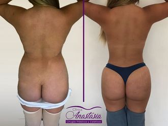 lipoescultura en hombres antes y despues de adelgazar