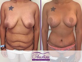 Lipo abdominoplastia + Levantamiento mamario con aumento