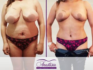 Abdominoplastia