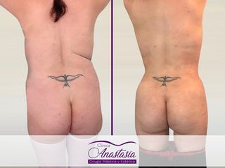 Lipoescultura