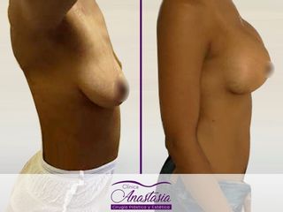antes y despues