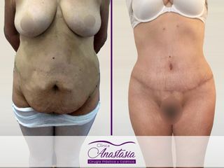 antes y despues