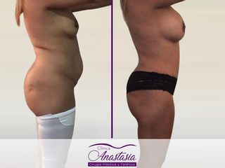 Lipo abdominoplastia con aumento mamario