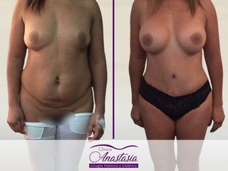 Lipo abdominoplastia con aumento mamario