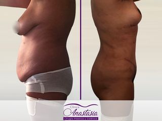 Lipo abdominoplastia con Reducción mamaria