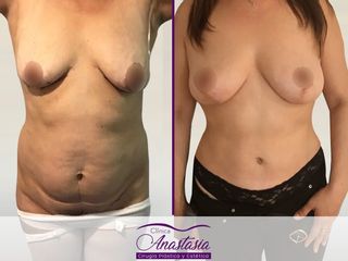 Lipo abdominoplastia con levantamiento mamario