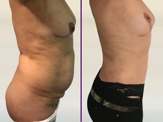 Lipo abdominoplastia con transferencia de grasa y levantamiento mamario