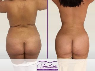 Lipoescultura